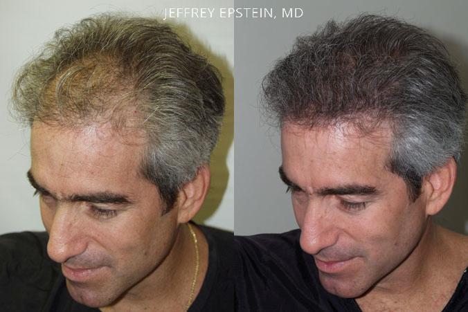 Hair Transplants for Men Before and after in Miami, FL, Paciente 38573