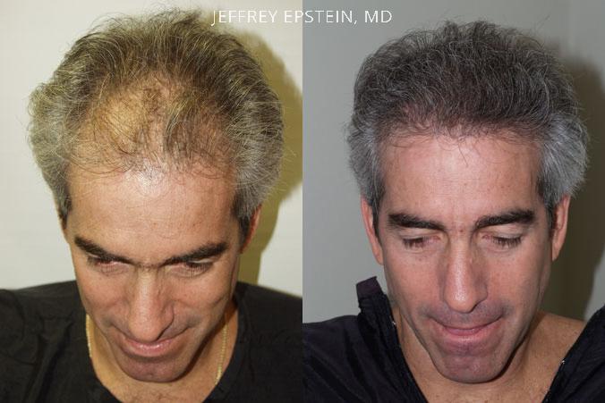 Hair Transplants for Men Before and after in Miami, FL, Paciente 38573