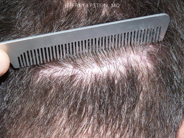 Hair Transplants for Men Before and after in Miami, FL, Paciente 38578