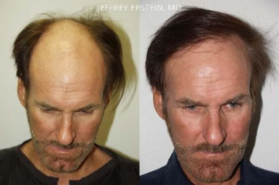 Hair Transplants for Men Before and after in Miami, FL, Paciente 38584