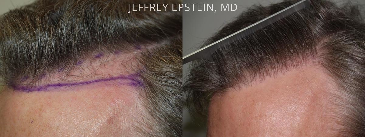 Hair Transplants for Men Before and after in Miami, FL, Paciente 38596