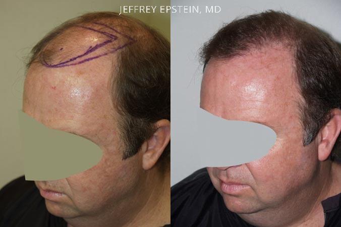 Hair Transplants for Men Before and after in Miami, FL, Paciente 38601
