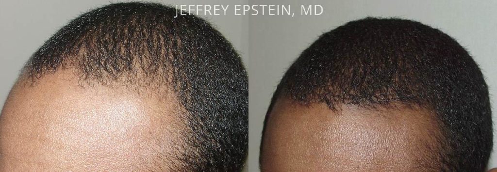 Antes y seis meses después de un procedimiento FUM de 1.800 injertos para rellenar el cabello adelgazante. 