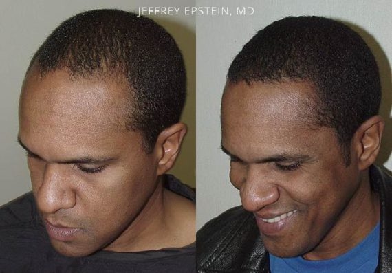 Trasplante de Pelo en Hombres Before and after in Miami, FL, Paciente 83334