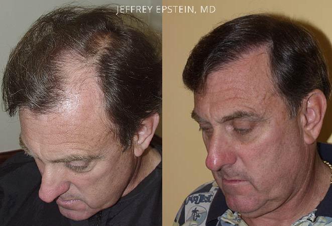 Hair Transplants for Men Before and after in Miami, FL, Paciente 38630