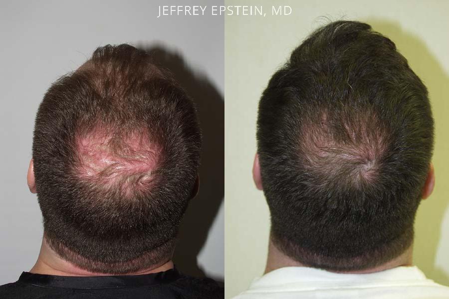 Hair Transplants for Men Before and after in Miami, FL, Paciente 38635