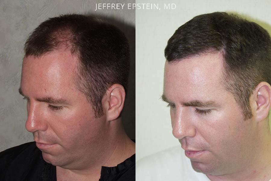 Hair Transplants for Men Before and after in Miami, FL, Paciente 38635
