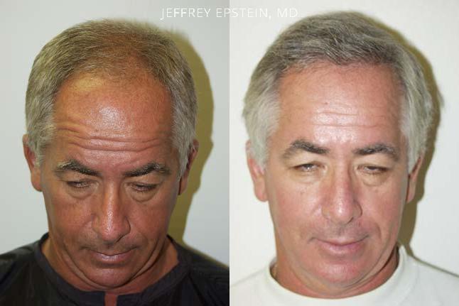 Hair Transplants for Men Before and after in Miami, FL, Paciente 38642