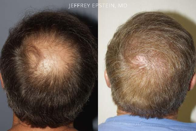 Hair Transplants for Men Before and after in Miami, FL, Paciente 38648