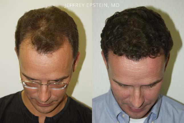 Hair Transplants for Men Before and after in Miami, FL, Paciente 38651