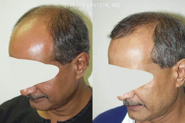 Hair Transplants for Men Before and after in Miami, FL, Paciente 38654