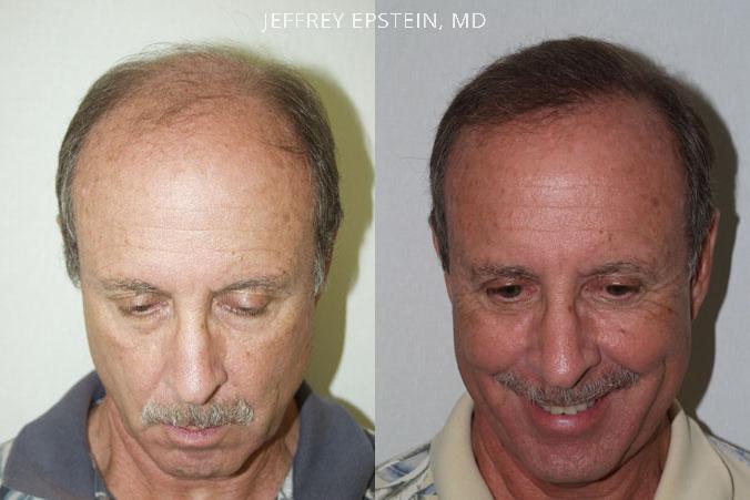Trasplante de Pelo en Hombres Antes y después en Miami, FL, Paciente 83121
