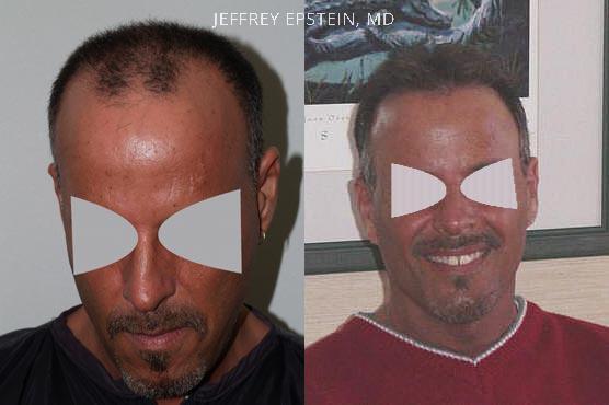 Hair Transplants for Men Before and after in Miami, FL, Paciente 38669