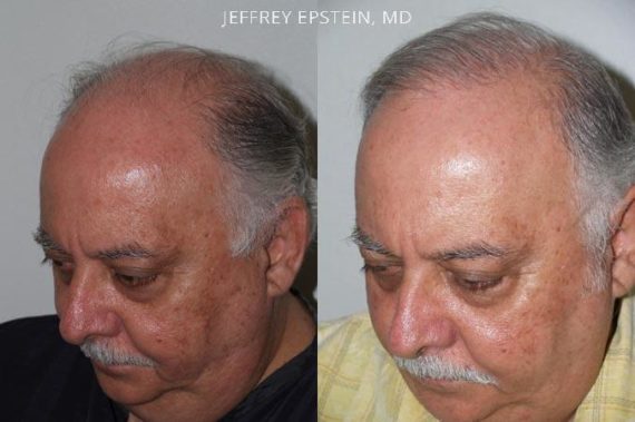 Trasplante de Pelo en Hombres Before and after in Miami, FL, Paciente 83079
