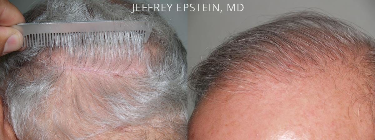 Hair Transplants for Men Before and after in Miami, FL, Paciente 38672