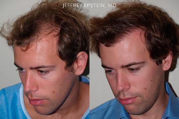 Hair Transplants for Men Before and after in Miami, FL, Paciente 38683