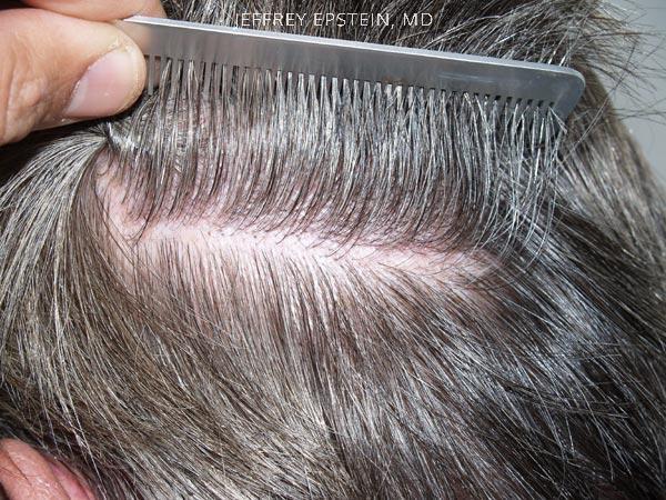 Hair Transplants for Men Before and after in Miami, FL, Paciente 38688