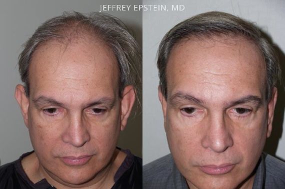 Trasplante de Pelo en Hombres Before and after in Miami, FL, Paciente 83012