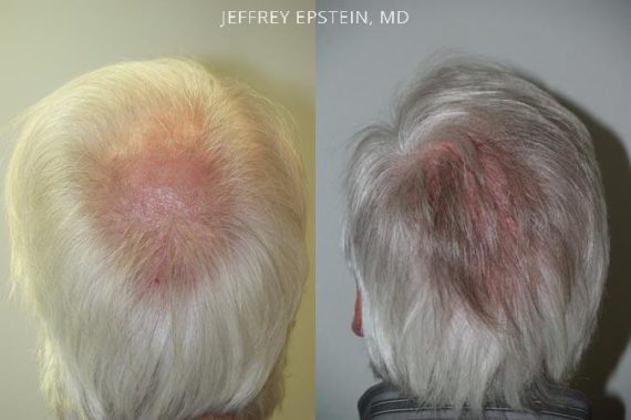 Trasplante de Pelo en Hombres Before and after in Miami, FL, Paciente 83001