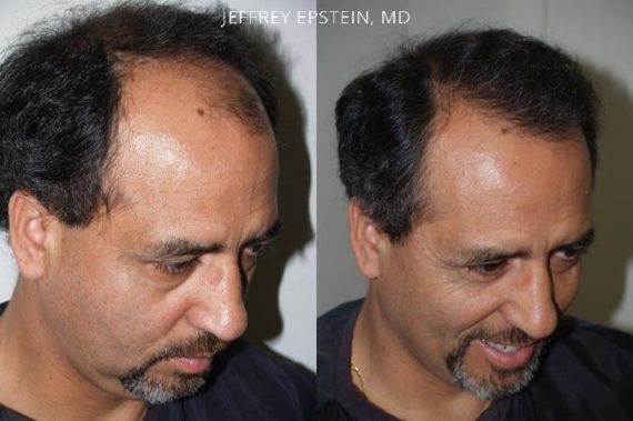 Trasplante de Pelo en Hombres Before and after in Miami, FL, Paciente 82960