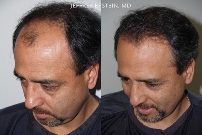 Hair Transplants for Men Before and after in Miami, FL, Paciente 38696