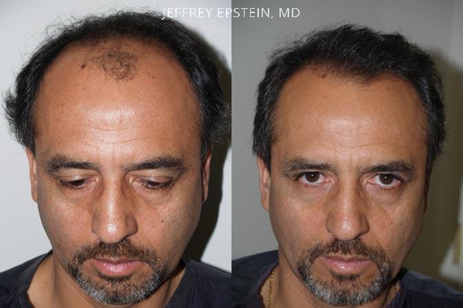 Hair Transplants for Men Before and after in Miami, FL, Paciente 38696