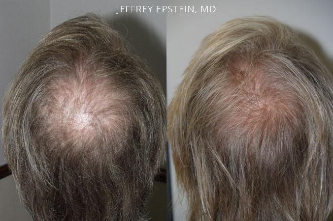 Hair Transplants for Men Before and after in Miami, FL, Paciente 38705
