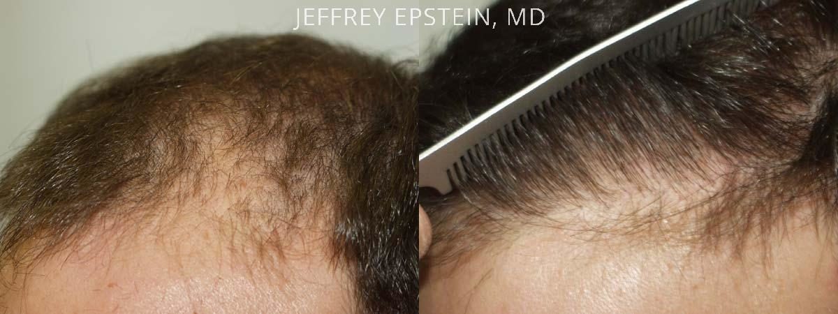 Hair Transplants for Men Before and after in Miami, FL, Paciente 38717