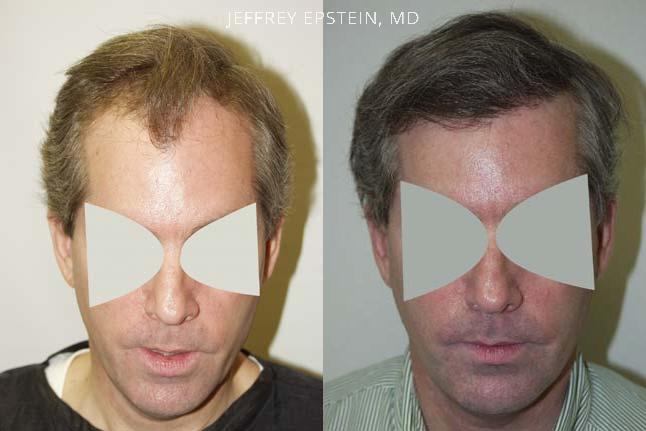Hair Transplants for Men Before and after in Miami, FL, Paciente 38724