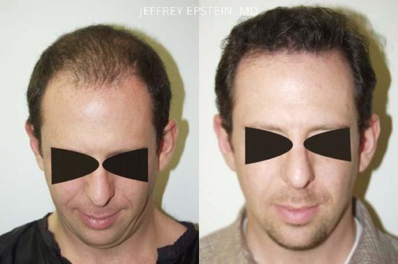 Trasplante de Pelo en Hombres Before and after in Miami, FL, Paciente 82816