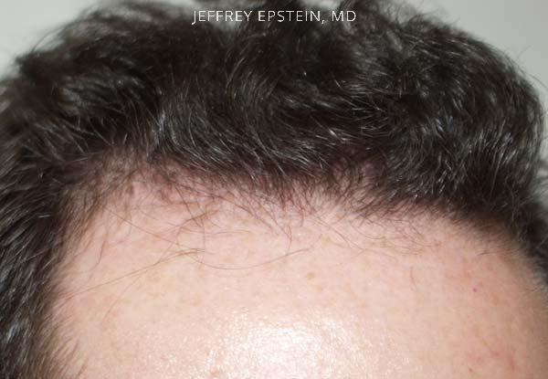 Hair Transplants for Men Before and after in Miami, FL, Paciente 38732