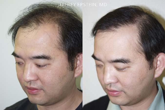 Hair Transplants for Men Before and after in Miami, FL, Paciente 38736