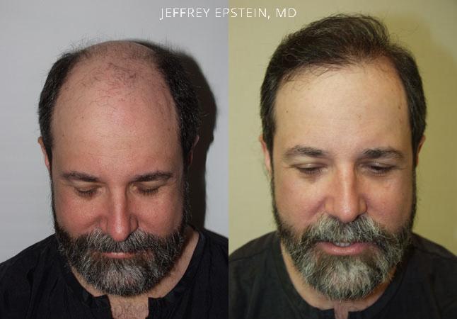 Hair Transplants for Men Before and after in Miami, FL, Paciente 38743