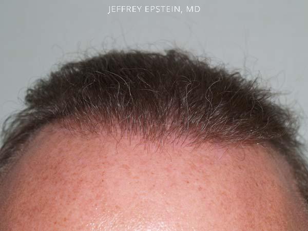 Hair Transplants for Men Before and after in Miami, FL, Paciente 38750
