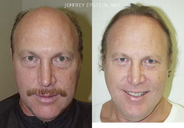 Hair Transplants for Men Before and after in Miami, FL, Paciente 38750