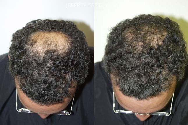 Hair Transplants for Men Before and after in Miami, FL, Paciente 38757