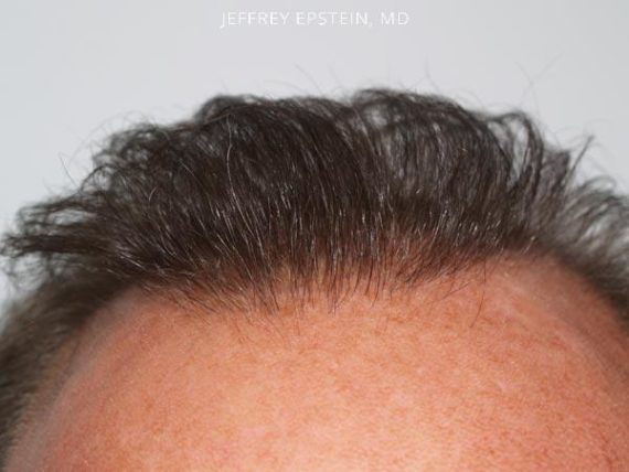 Hair Transplants for Men Before and after in Miami, FL, Paciente 38760