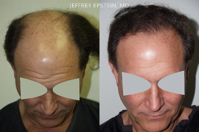 Hair Transplants for Men Before and after in Miami, FL, Paciente 38764