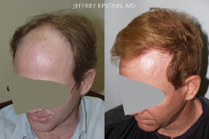 Hair Transplants for Men Before and after in Miami, FL, Paciente 38769