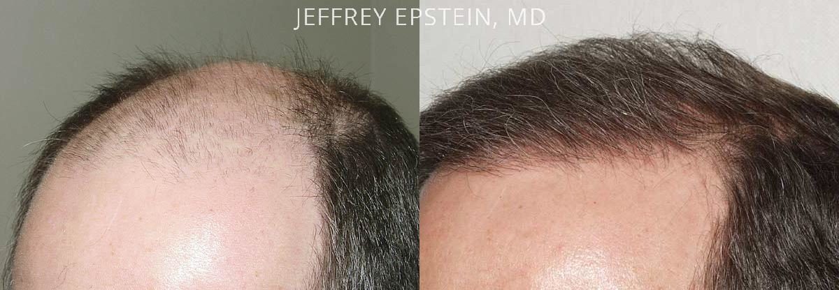 Hair Transplants for Men Before and after in Miami, FL, Paciente 38774