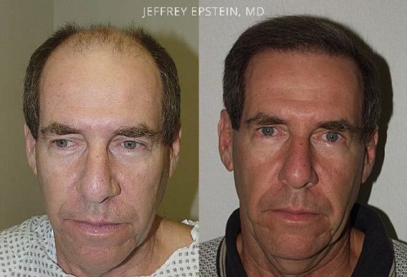 Trasplante de Pelo en Hombres Before and after in Miami, FL, Paciente 82604