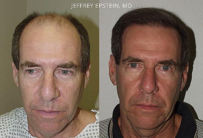 Hair Transplants for Men Before and after in Miami, FL, Paciente 38774