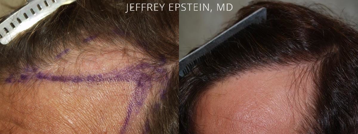 Hair Transplants for Men Before and after in Miami, FL, Paciente 38784