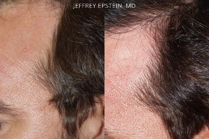 Hair Transplants for Men Before and after in Miami, FL, Paciente 38784