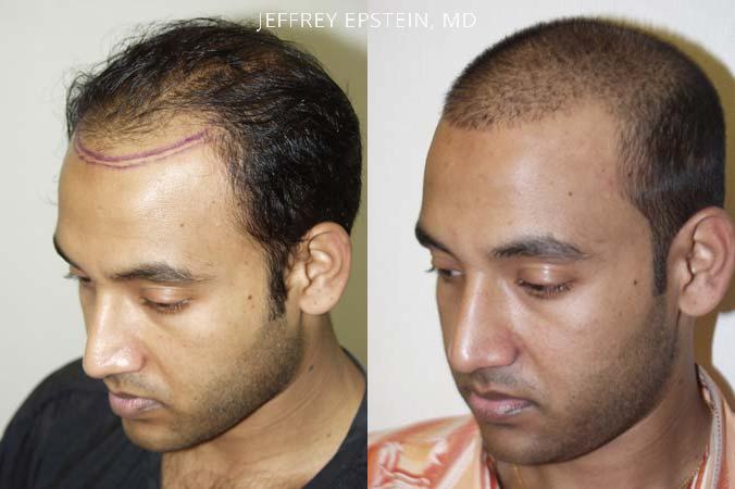 Hair Transplants for Men Before and after in Miami, FL, Paciente 38797