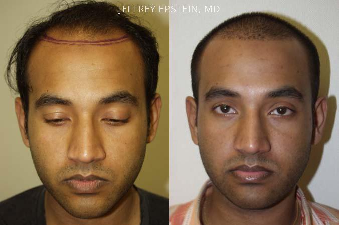 Hair Transplants for Men Before and after in Miami, FL, Paciente 38797