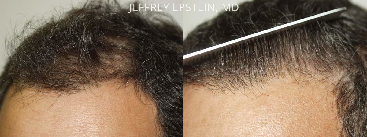 Hair Transplants for Men Before and after in Miami, FL, Paciente 38802