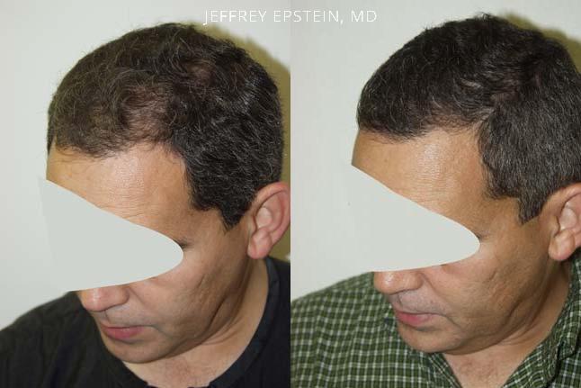 Hair Transplants for Men Before and after in Miami, FL, Paciente 38802