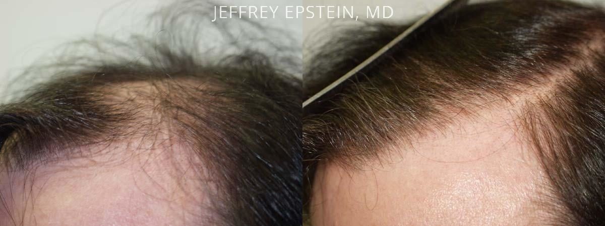 Hair Transplants for Men Before and after in Miami, FL, Paciente 38807