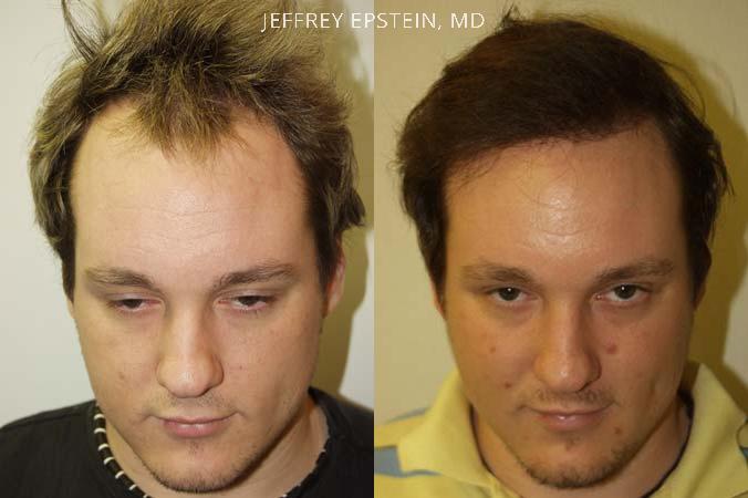 Hair Transplants for Men Before and after in Miami, FL, Paciente 38812